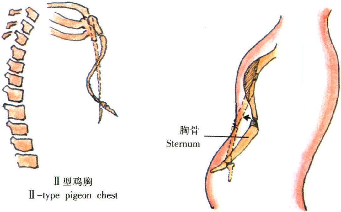 雞胸矯形術